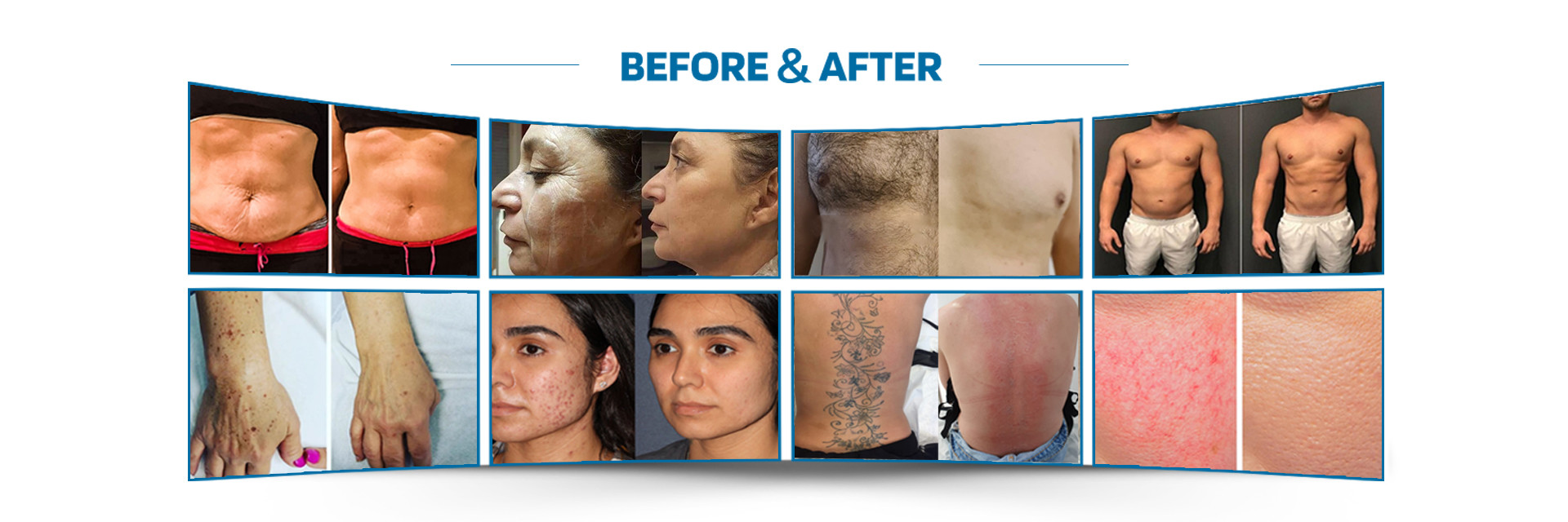 품질 레이저 모발 제거 기계 공장