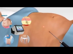레이저 리포 장비 30W 60W 980nm 다이오드 리포 레이저 기계 체중 감량